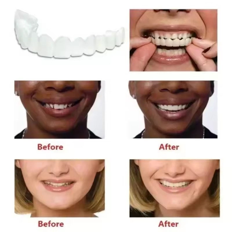 Okładziny na zęby Wybielanie z – Teeth Whitening For Braces recenzja i cena
