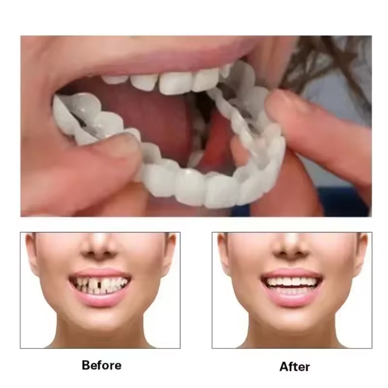 Okładziny na zęby Wybielanie z – Teeth Whitening For Braces recenzja i cena