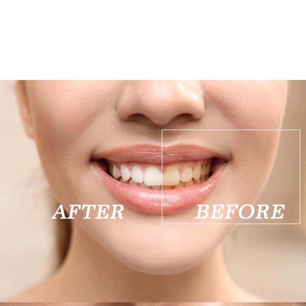 Najwyższej jakości zestaw żelo – Teeth Whitening Gels recenzja i cena