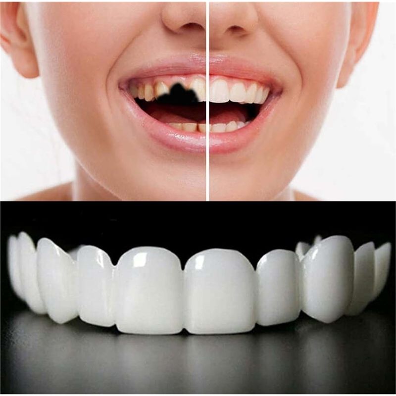 [NOWOŚĆ! ABMK】 2 Pary, Przywró – Teeth Whitening For Braces recenzja i cena