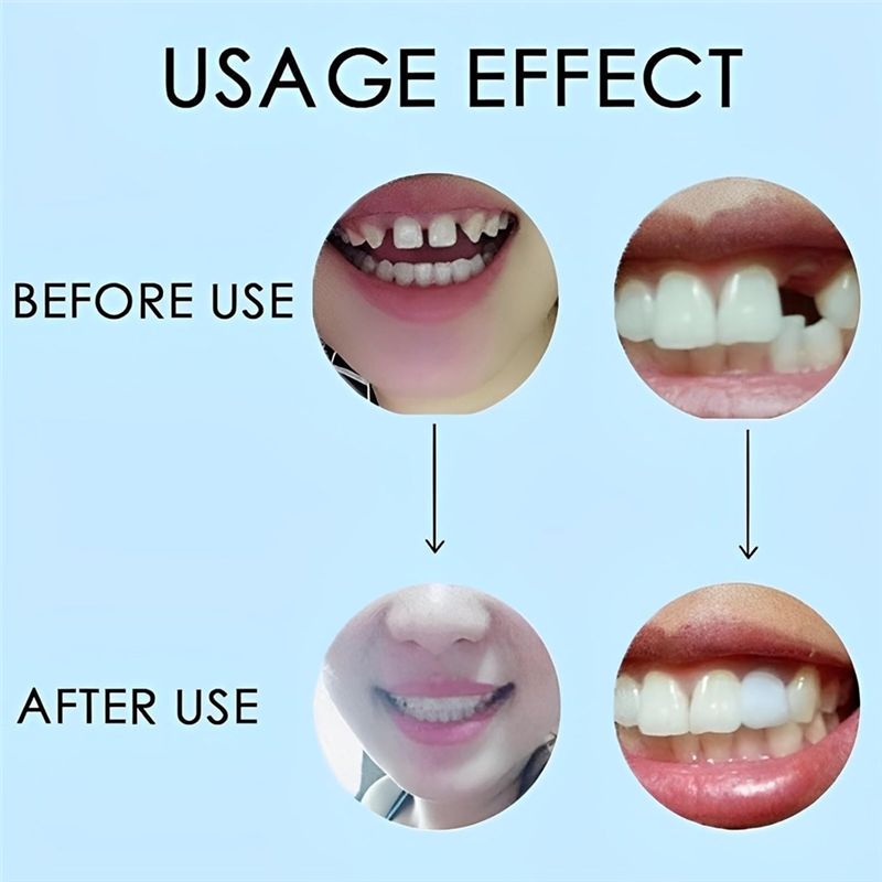 [NOWOŚĆ! ABMK】 2 Pary, Przywró – Teeth Whitening For Braces recenzja i cena